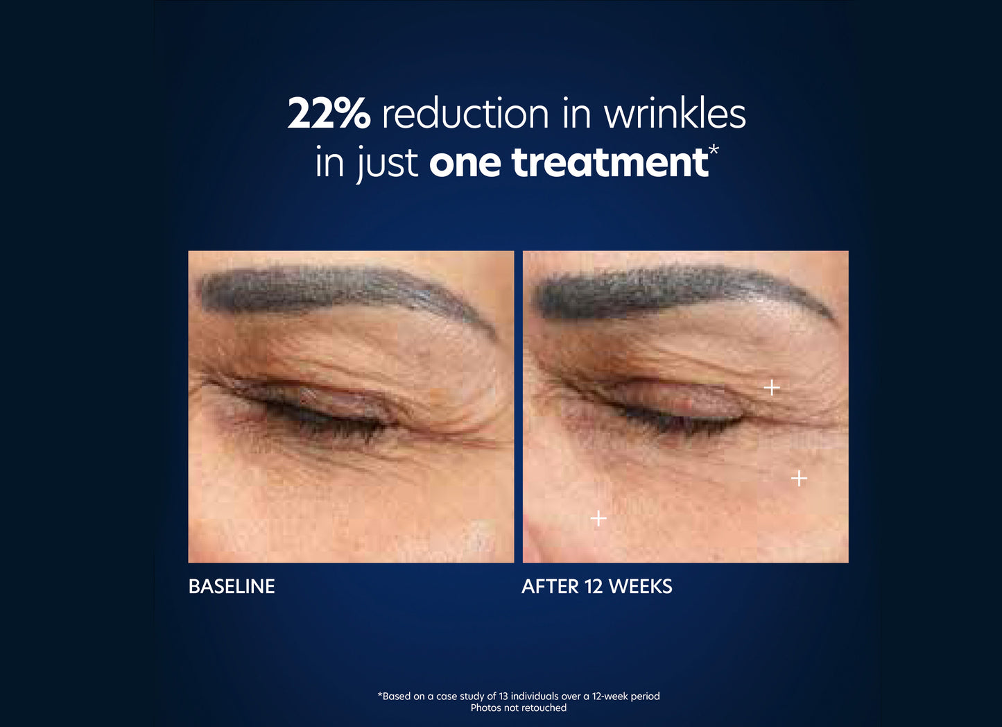 22% reduction in wrinkles in just one treatment