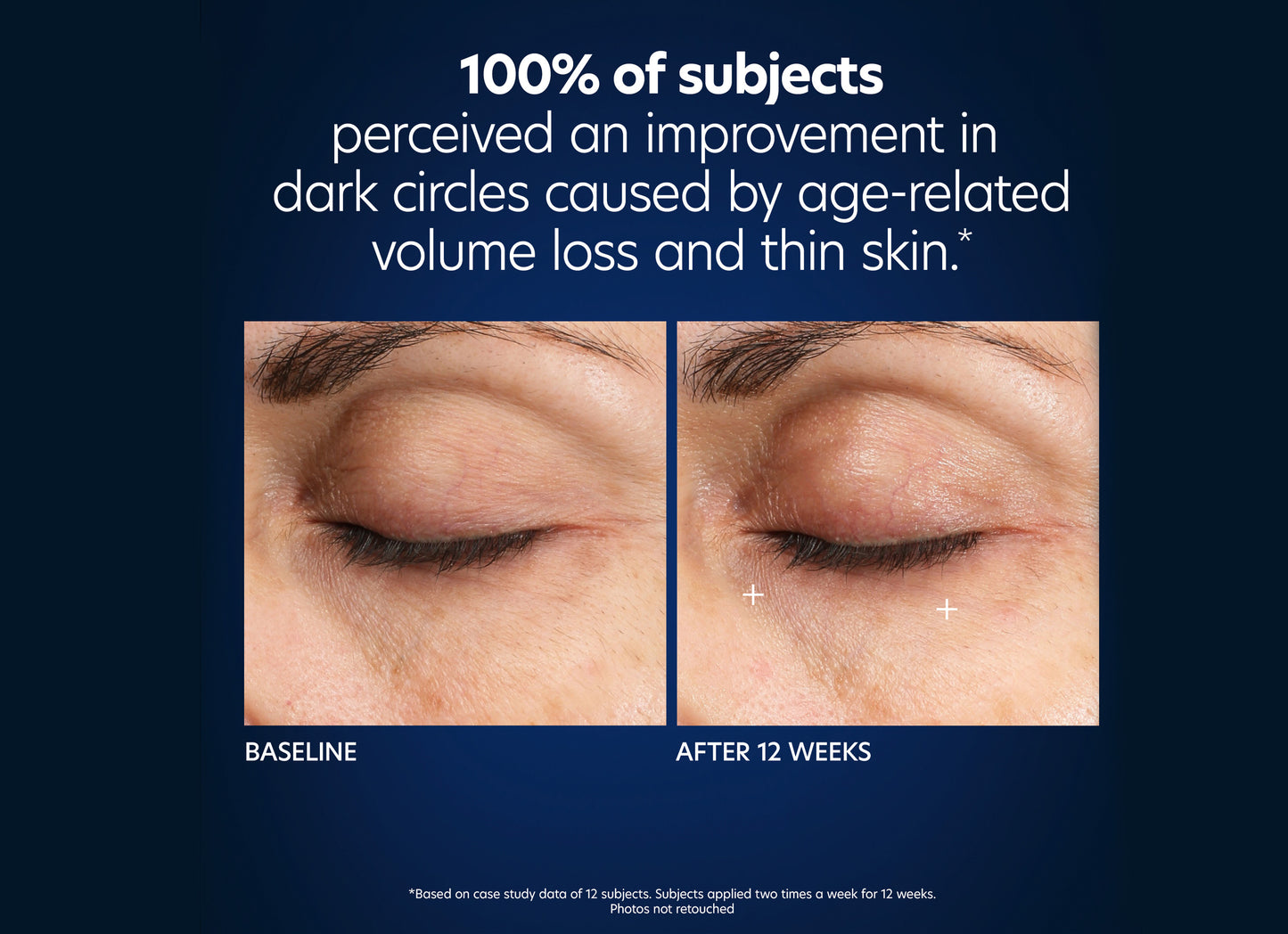 100% of subject perceived an improvement in dark circles