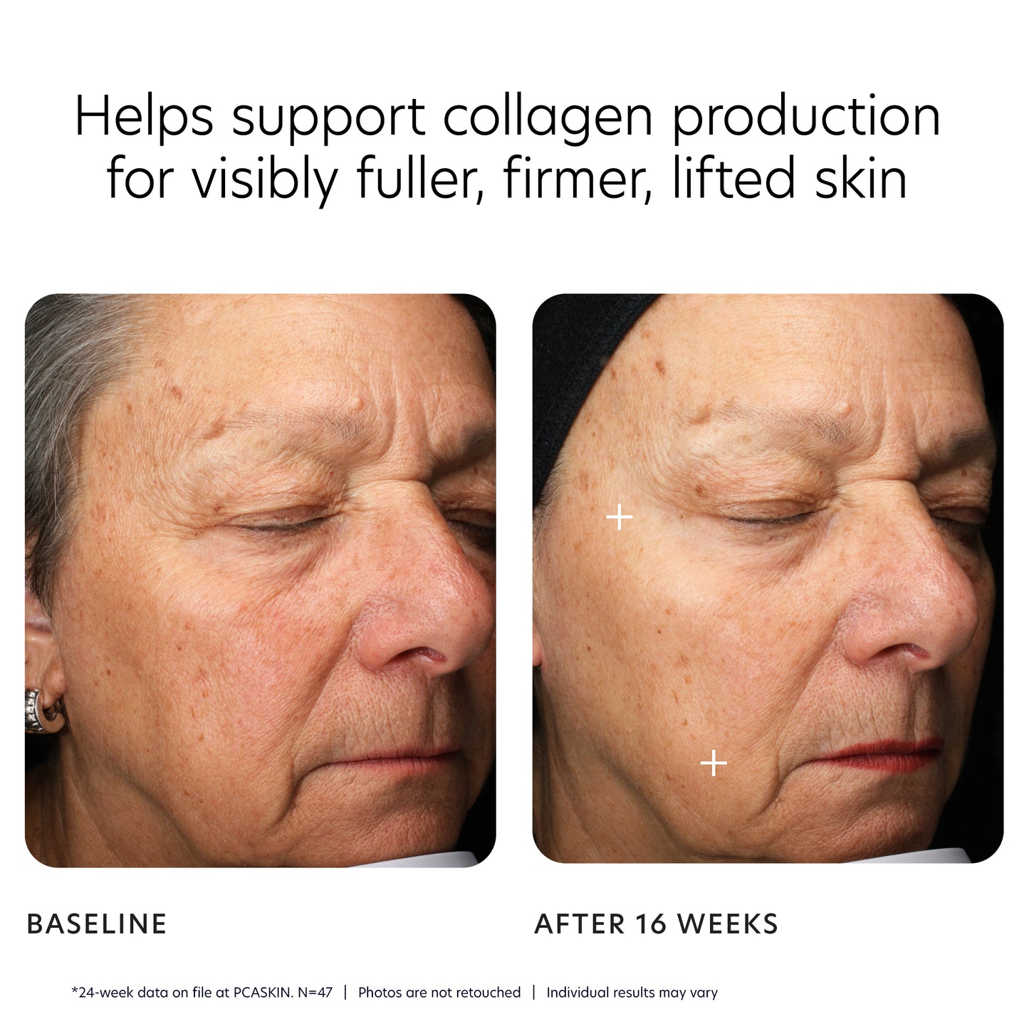 Before and after comparison of facial skin with text about collagen support.