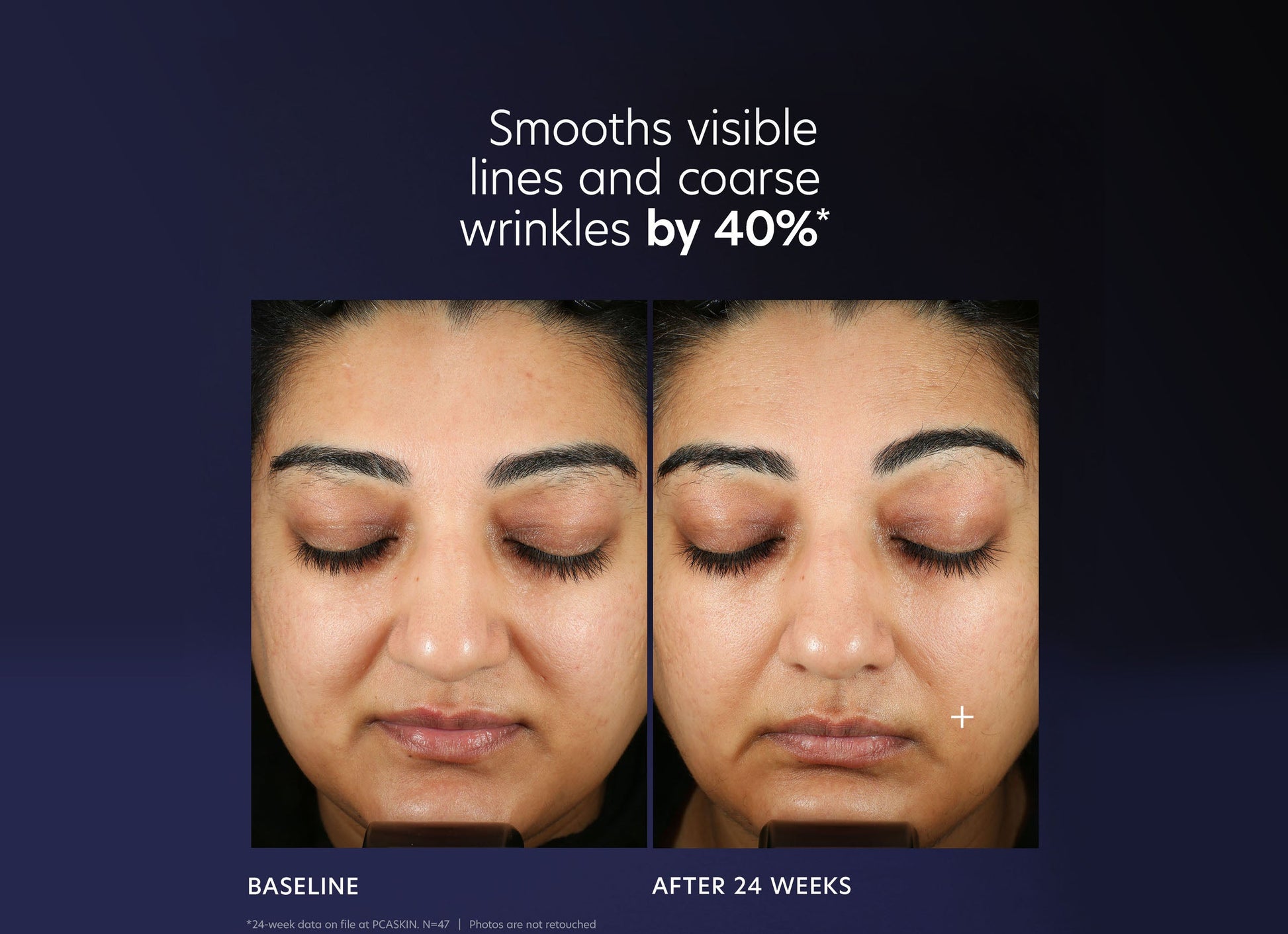 Pro-Max Age Renewal. B&A 40% Smooths visible lines